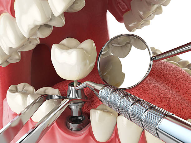 Best Emergency Tooth Extraction in Walnut Park, CA